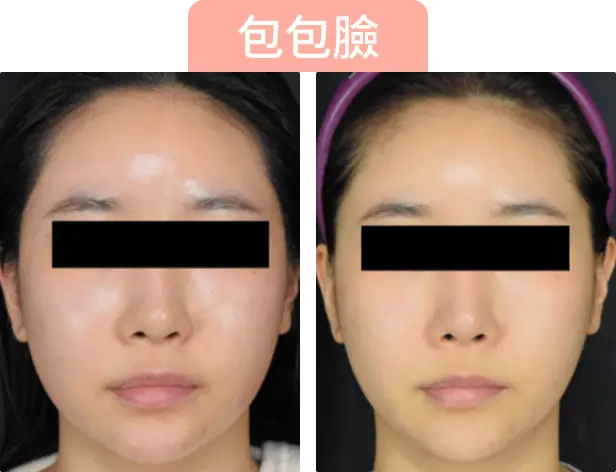 兩張女性的面部照片，顯示面部治療前後的對比。左側為Onda Pro溶脂治療前，右側為治療後。