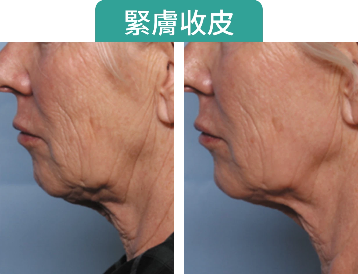 左右對比兩張面部側影，左��側顯示皮膚鬆弛，右側顯示緊緻效果，顯示Onda Pro 溶脂後的改善效果。上方有「緊膚收皮」文字。