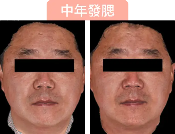 中年男子的面部特寫，左側與右側有所不同，顯示Onda Pro治療後效果，標題為「中年發腮」。