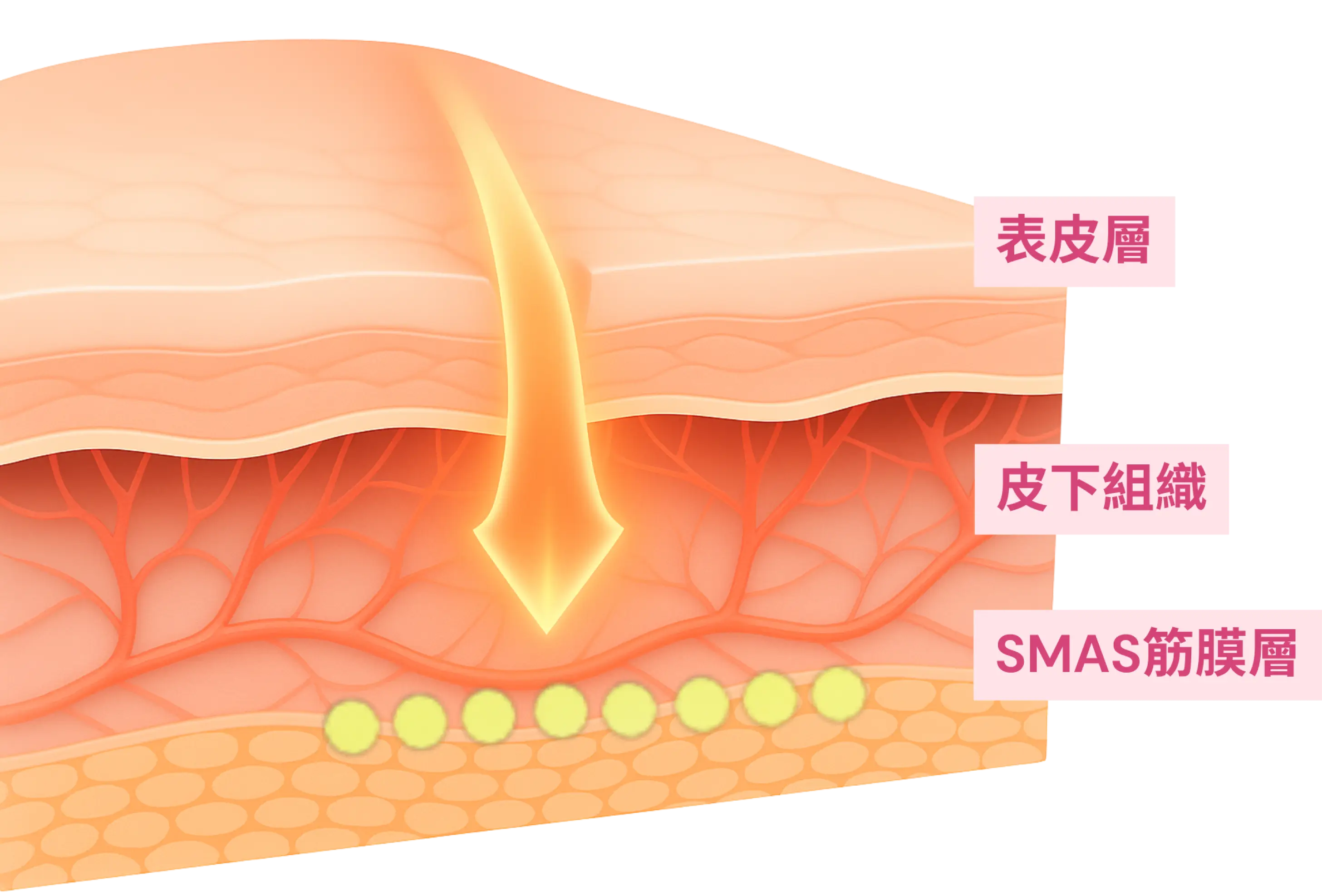 深入SMAS筋膜層 (1).webp