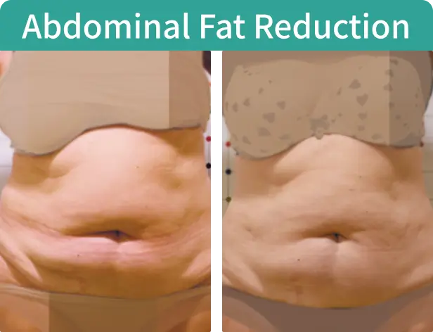 Abdominal Fat Reduction-2.webp