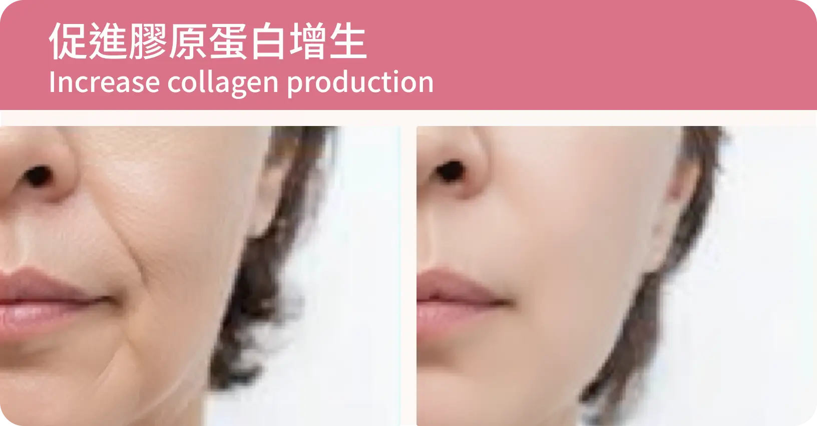 促進膠原蛋白增生（皮秒治療前後對比：左邊有皺紋，右邊皮膚平滑）