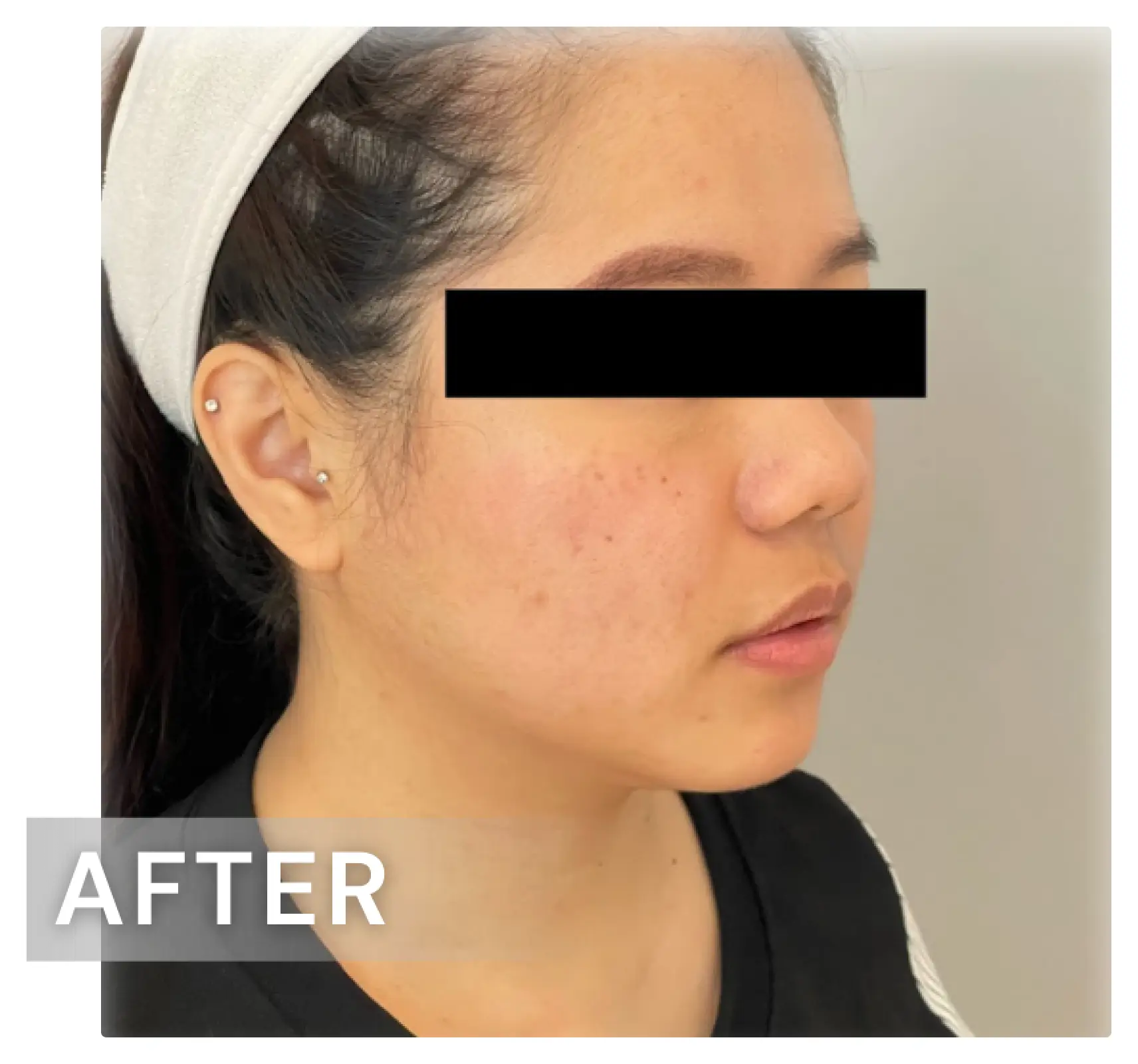 雙下巴療程案例03-after.webp