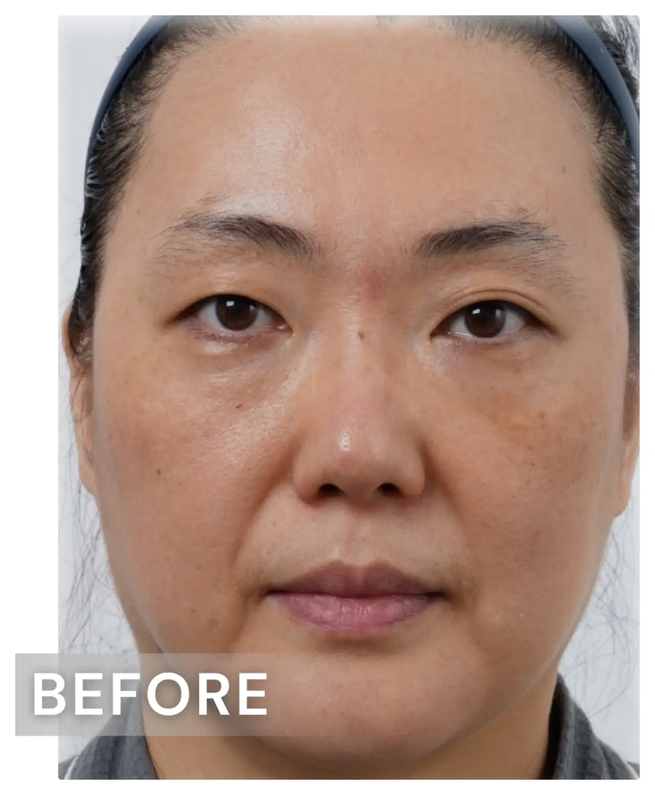 面部皺紋-before.webp