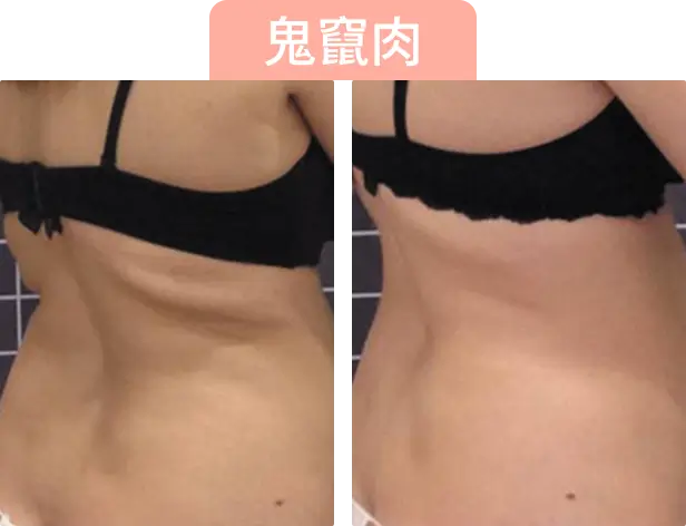 對比兩張女性側身照片，左側顯示較多腹部脂肪，右側則較為纖瘦。上方有“鬼竄肉”字樣。