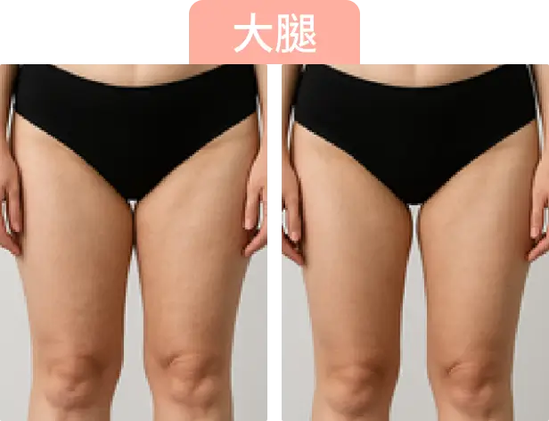 左右兩側腿部的比較圖，大腿明顯在Onda Pro治療後腿部變細。