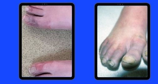 Close-up of toes. Left shows red, swollen toes; right shows toes with discolored nails.