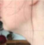 double chin treatments vancouver