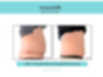 belly-fat-vancouver.jpg