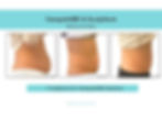 mommy-pooch-belly-fat-sculpsure-vancouver.jpg