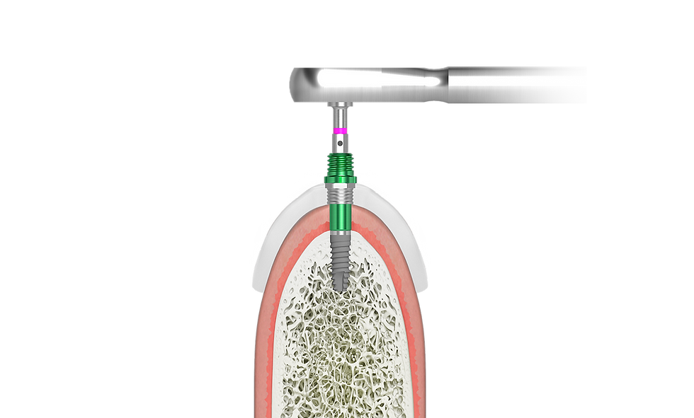 POSIZIONAMENTO IMPLANTARE IUXTAOSSEO-PREMIUM.png