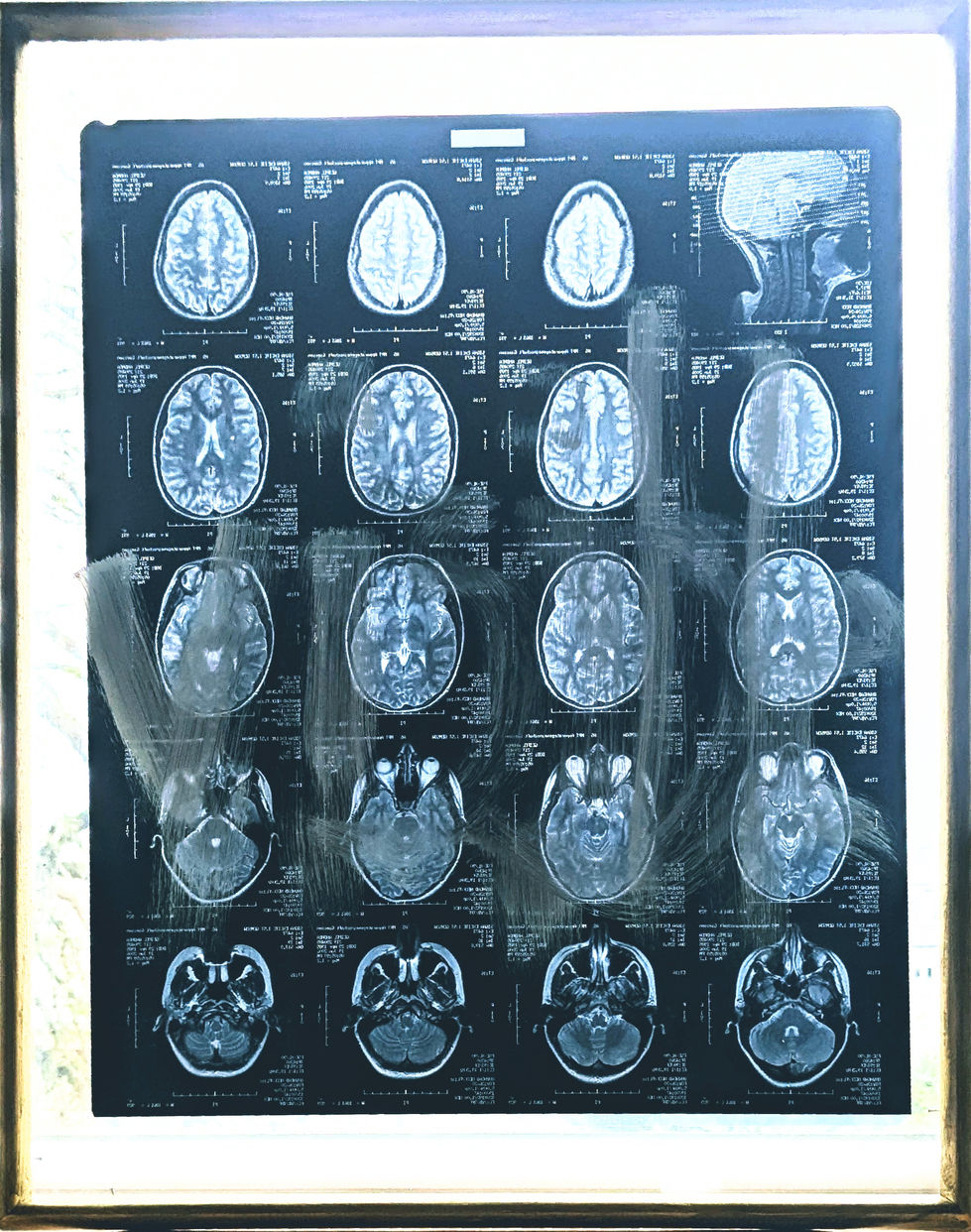 Photograph of the MRI image with the word "visible" written on it. The writing is barely legible.