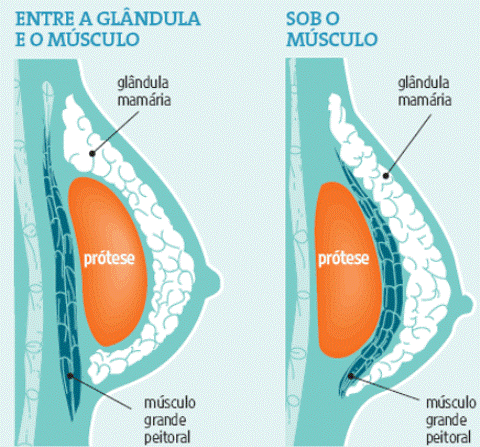 Mamoplastia de aumento: o que é preciso saber sobre a cirurgia de expansão dos seios