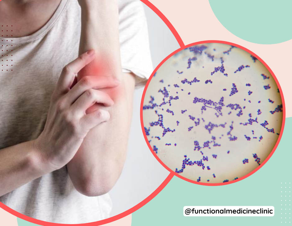 Signs of Candida Overgrowth in your body!