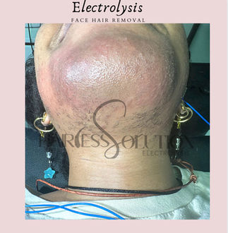 permanent hair removal