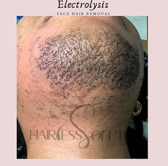 permanent hair removal