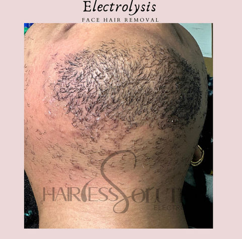 permanent hair removal