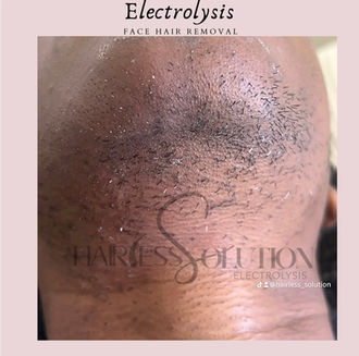 permanent hair removal