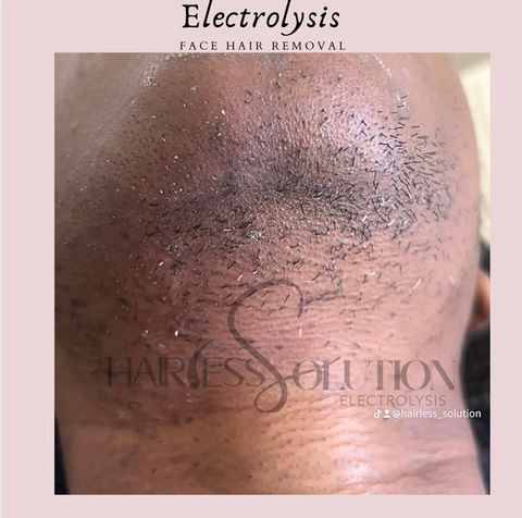 permanent hair removal