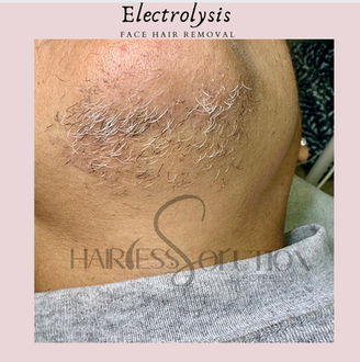 ingrown hair treatment, ga