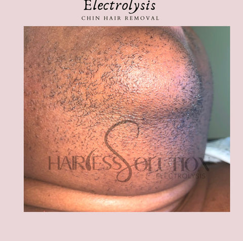permanent hair removal