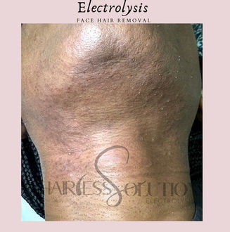 permanent hair removal