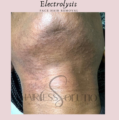 permanent hair removal
