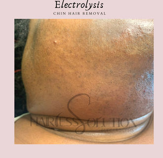permanent hair removal