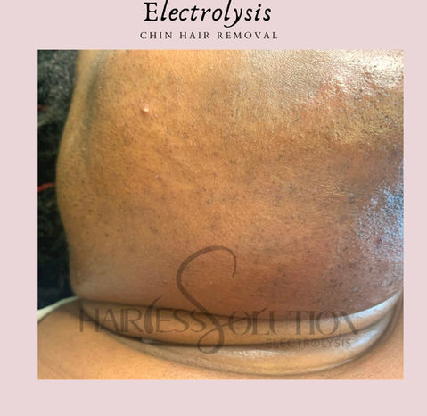 permanent hair removal
