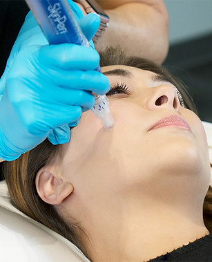 skinpen-microneedling-patient.jpg