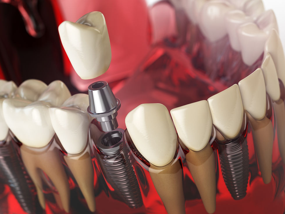 Eye-level view of a dental implant procedure in progress