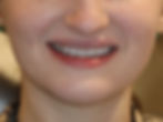 Veneers-After.jpg