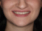 Veneers-Before.jpg
