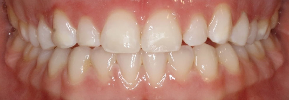 whitening-after.jpg