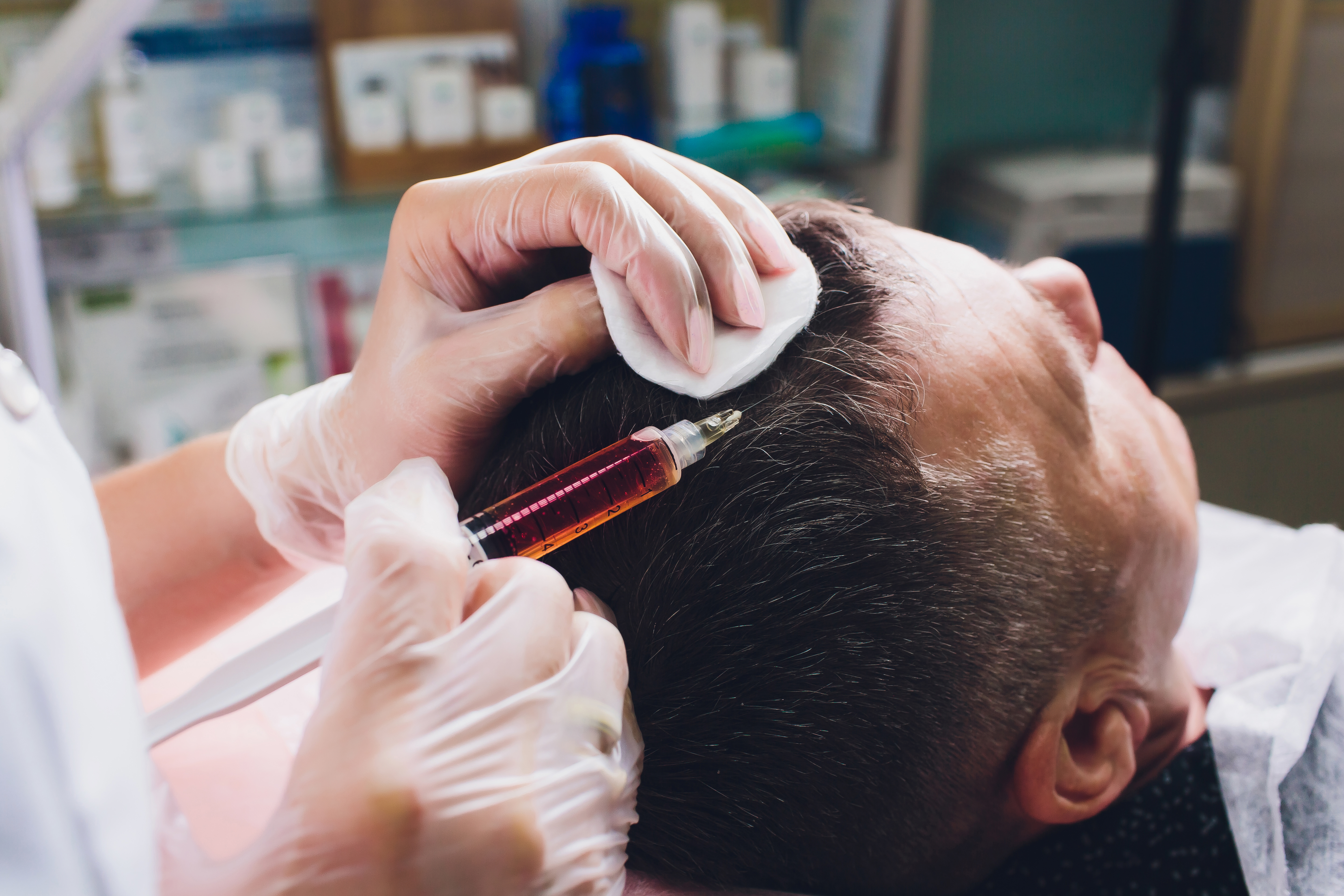 PRP hair restoration treatment at Pureté Medical Spa in Etobicoke, serving clients from Mimico, South Etobicoke, New Toronto, and Mississauga