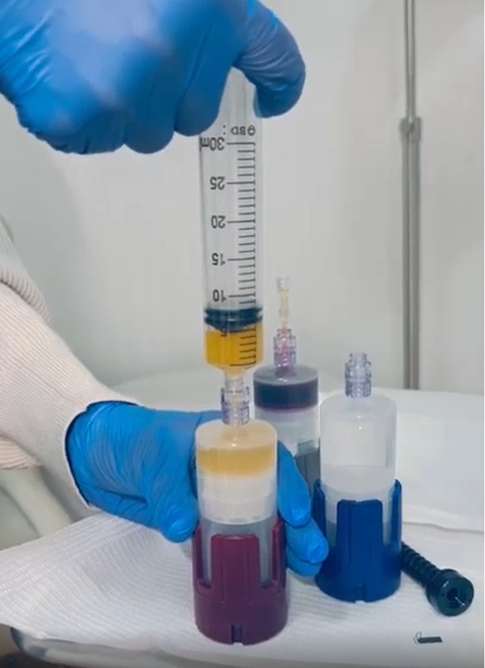 PRP bio-filler preparation used as a natural filler option in a medical spa setting