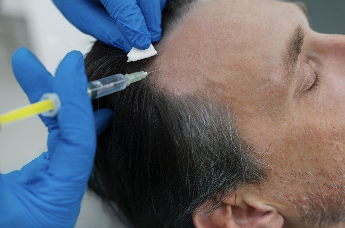 Man receiving mesotherapy scalp injection for hair loss treatment in Etobicoke clinic