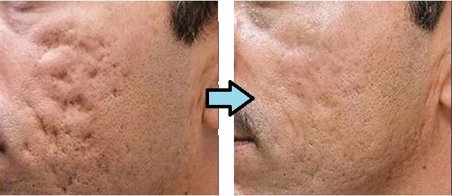 Before and after PRP facial treatment showing reduced acne scars – Pureté Medical Spa Etobicoke