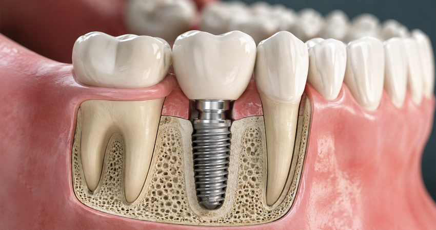Dental implant - Diş implantı