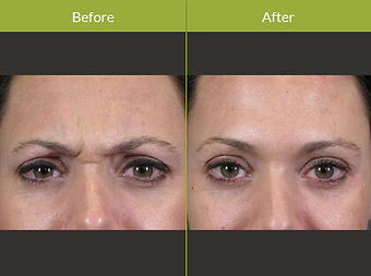 botox-before-and-after-photo-new_edited.