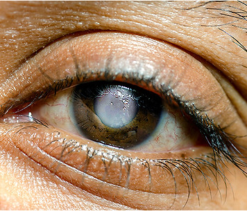Glaucoma-banner-new.jpg