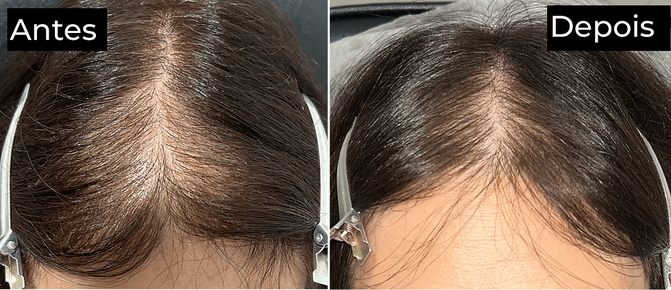regeneracao-capilar-alopecia-feminina-antes-depois.png