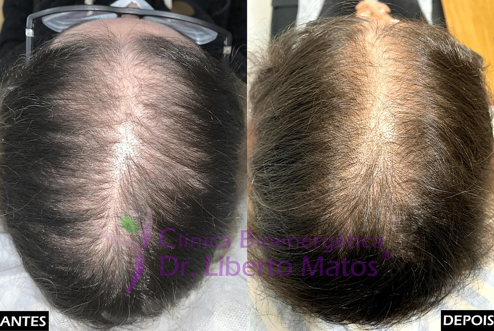 Caso clínico de sucesso no tratamento da alopecia androgenética feminina. Imagem comparativa mostrando o aumento expressivo do volume e espessura do cabelo sem recurso a transplante