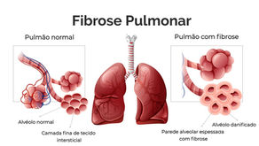 Fibrose Pulmonar: Sintomas, Causas e Tratamentos Eficazes