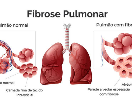 Fibrose Pulmonar: Sintomas, Causas e Tratamentos Eficazes