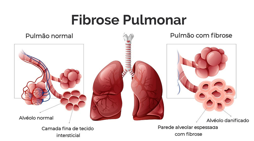 fibrose pulmonar