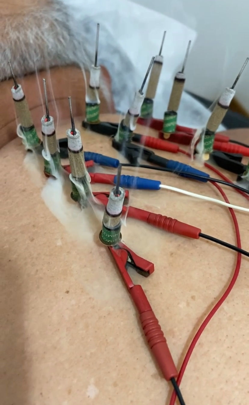 tratamento de acupuntura com eletroestimulação para parar de fumar