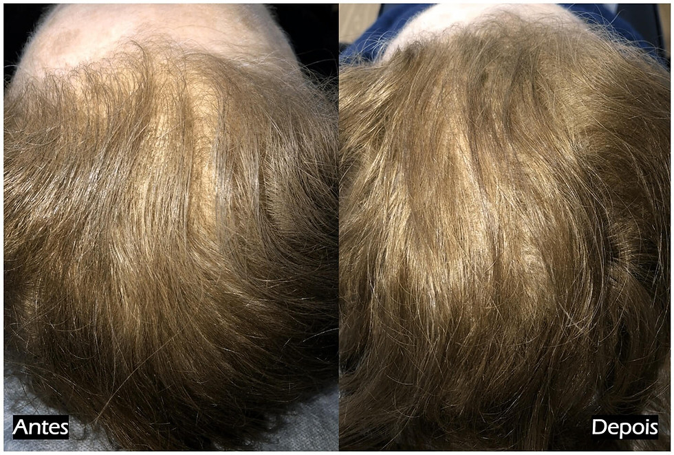 Antes e depois do tratamento de alopecia nas Clínicas Dr. Liberto Matos. Aumento visível da densidade capilar e preenchimento folicular na zona superior do couro cabeludo