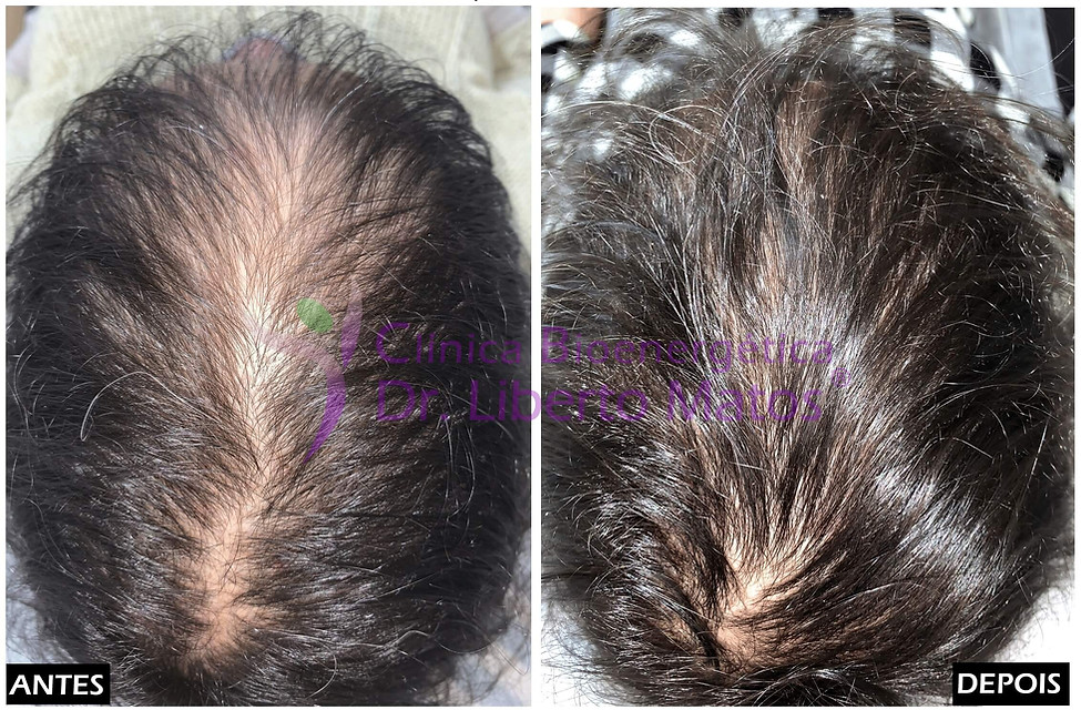 Antes e depois demonstrando o espessamento capilar e a redução da visibilidade do couro cabeludo na zona da risca, revertendo os sintomas de miniaturização folicular feminina