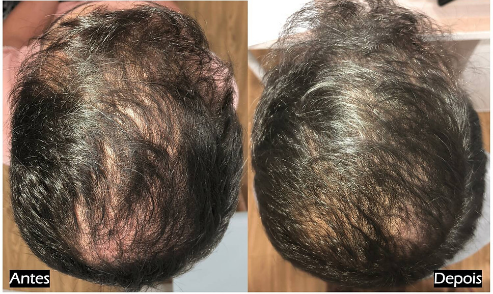Antes e depois do tratamento da calvície masculina na coroa. Recuperação visível da densidade capilar e preenchimento folicular através do método clínico do Dr. Liberto Matos